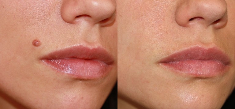 До и после лазерного удаления родинки на лице